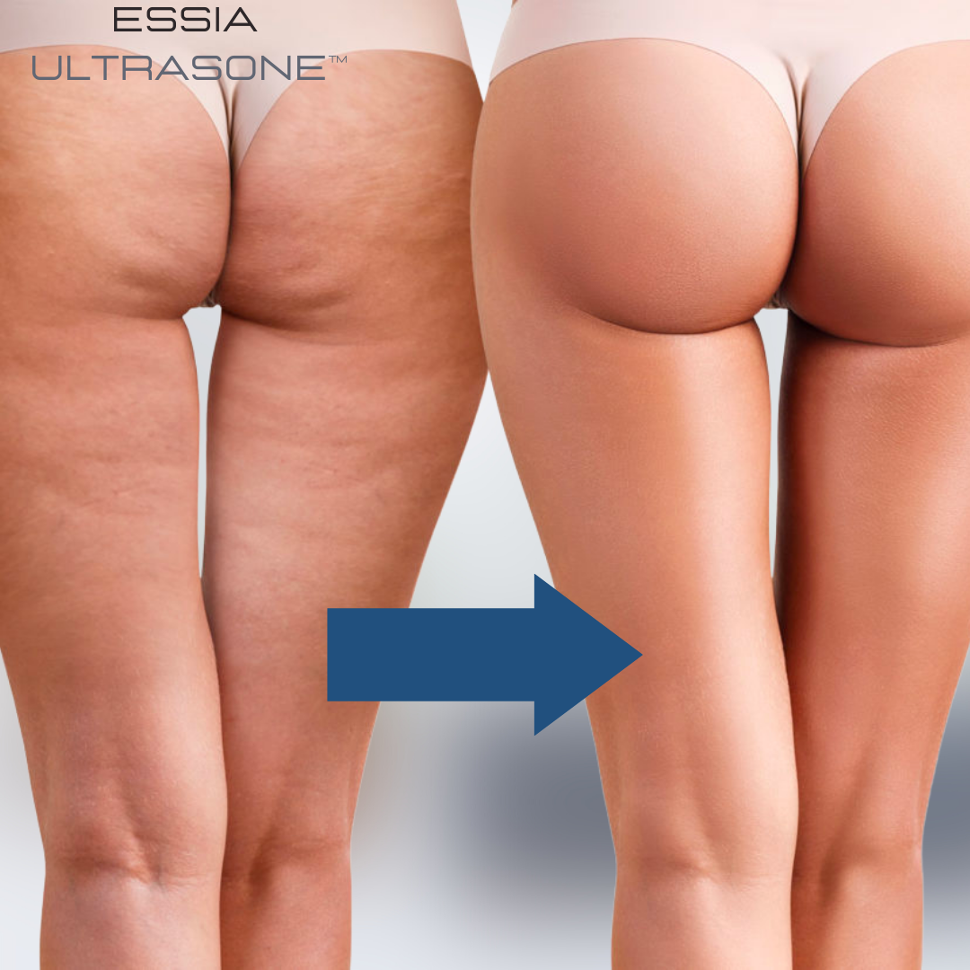 Essia Ultrasone™ | 3-in-1 Ganzkörper-Transformationsgerät für Ihre Traumfigur