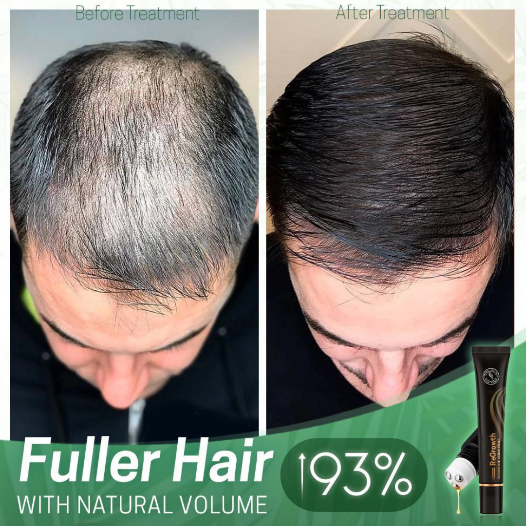 Revitalize Bio Hair Serum™ | Fördere dein Haarwachstum – 1+1 GRATIS Angebot!