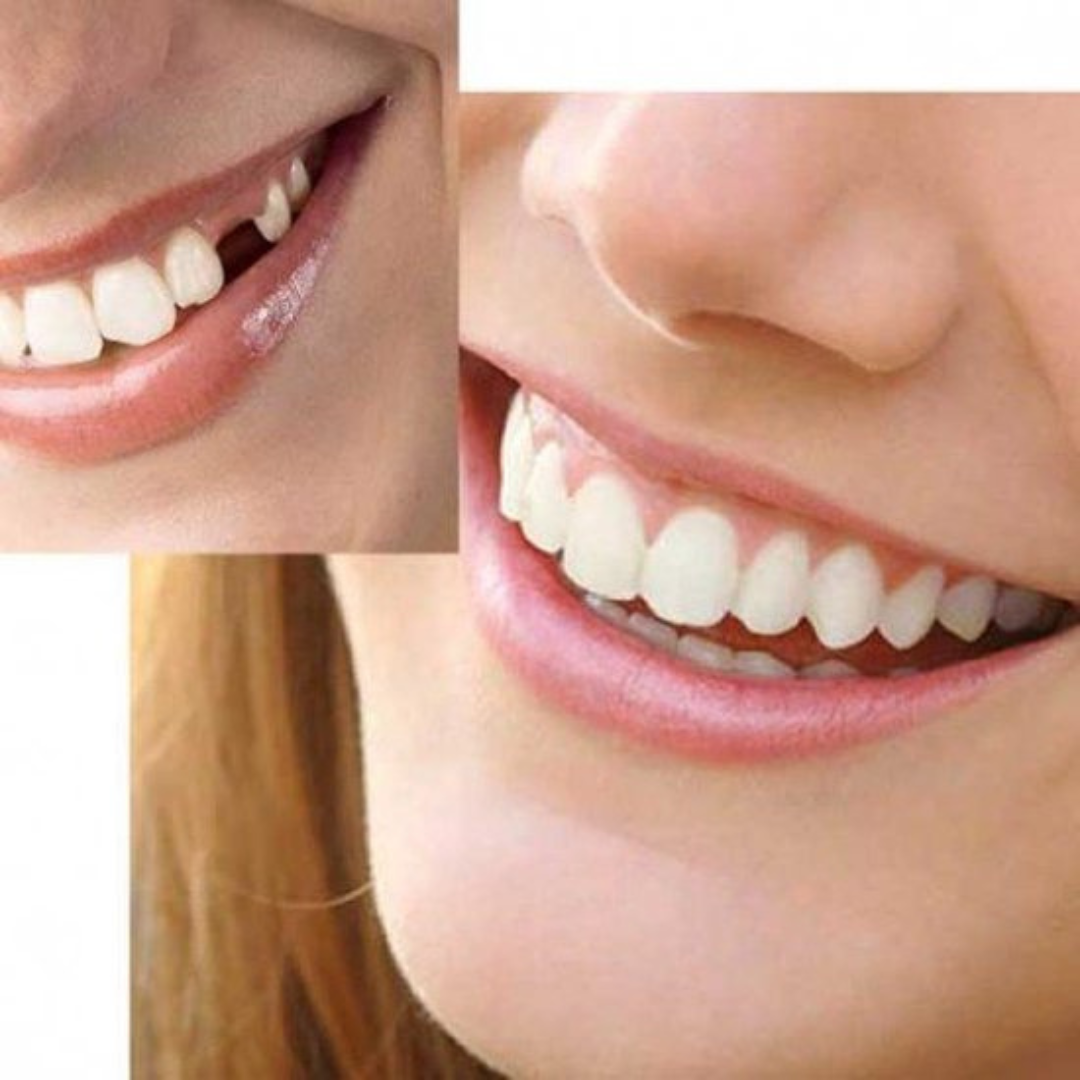 HiSmile Zahnverschönerungs-Kit | Erziele traumhaft schöne Zähne in nur wenigen Minuten!