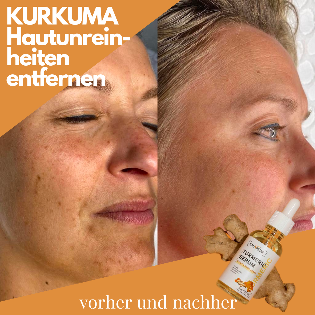 DermaSkin™ | Fleckenentferner-Serum – Holen Sie sich 1 GRATIS dazu!