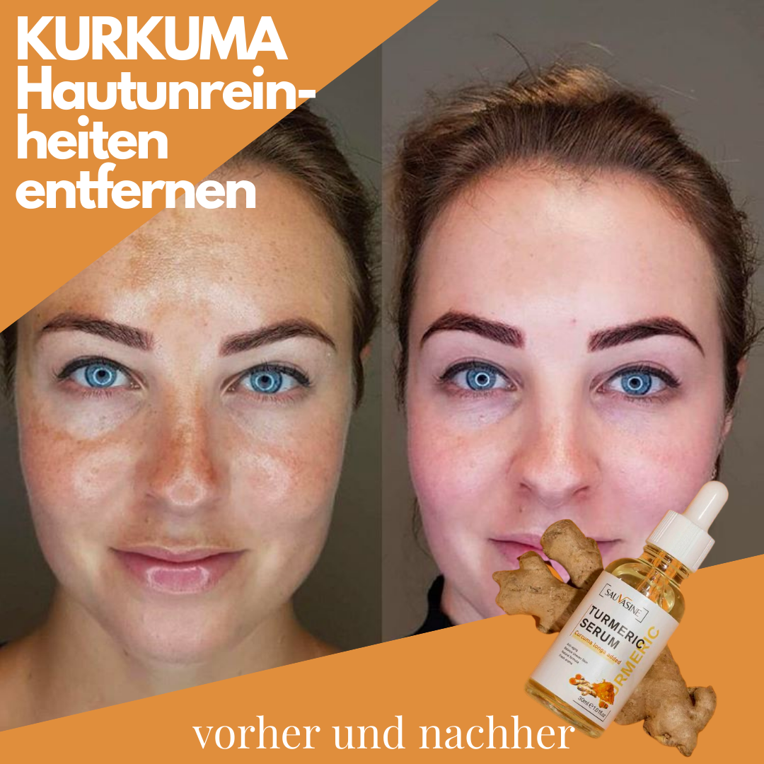 DermaSkin™ | Fleckenentferner-Serum – Holen Sie sich 1 GRATIS dazu!