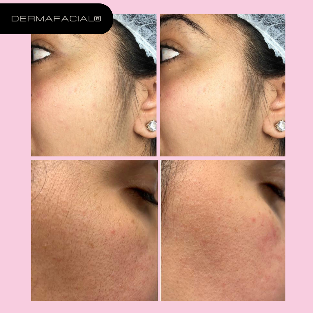 Derma Facial© | Strahlende, gleichmäßige Haut in Minuten!