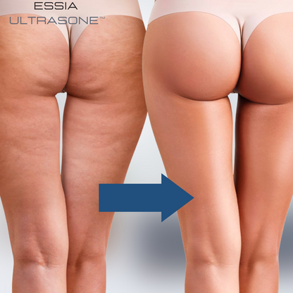 Essia Ultrasone™ | 3-in-1 Ganzkörper-Transformationsgerät für Ihre Traumfigur