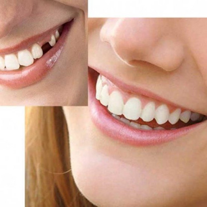 HiSmile Zahnverschönerungs-Kit | Erziele traumhaft schöne Zähne in nur wenigen Minuten!