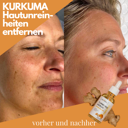 DermaSkin™ | Fleckenentferner-Serum – Holen Sie sich 1 GRATIS dazu!